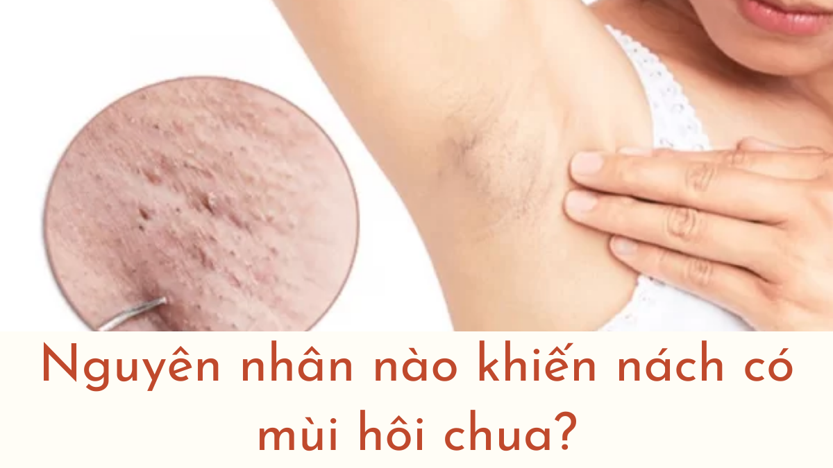 Nách Có Mùi Chua: Nguyên Nhân Và Cách Khắc Phục