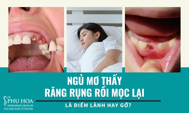 Nằm Mơ Mọc Răng: Giải Mã Giấc Mơ Và Ý Nghĩa