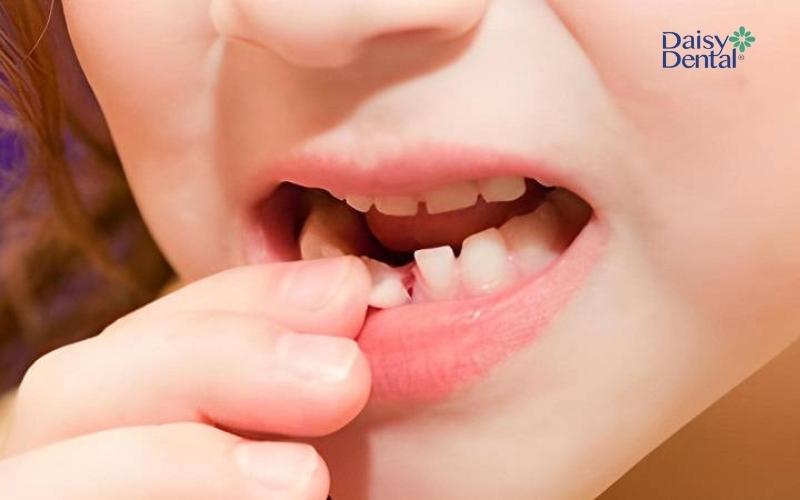 Nằm Mơ Răng Lung Lay Có Ý Nghĩa Gì? Giải Mã Giấc Mơ Chi Tiết