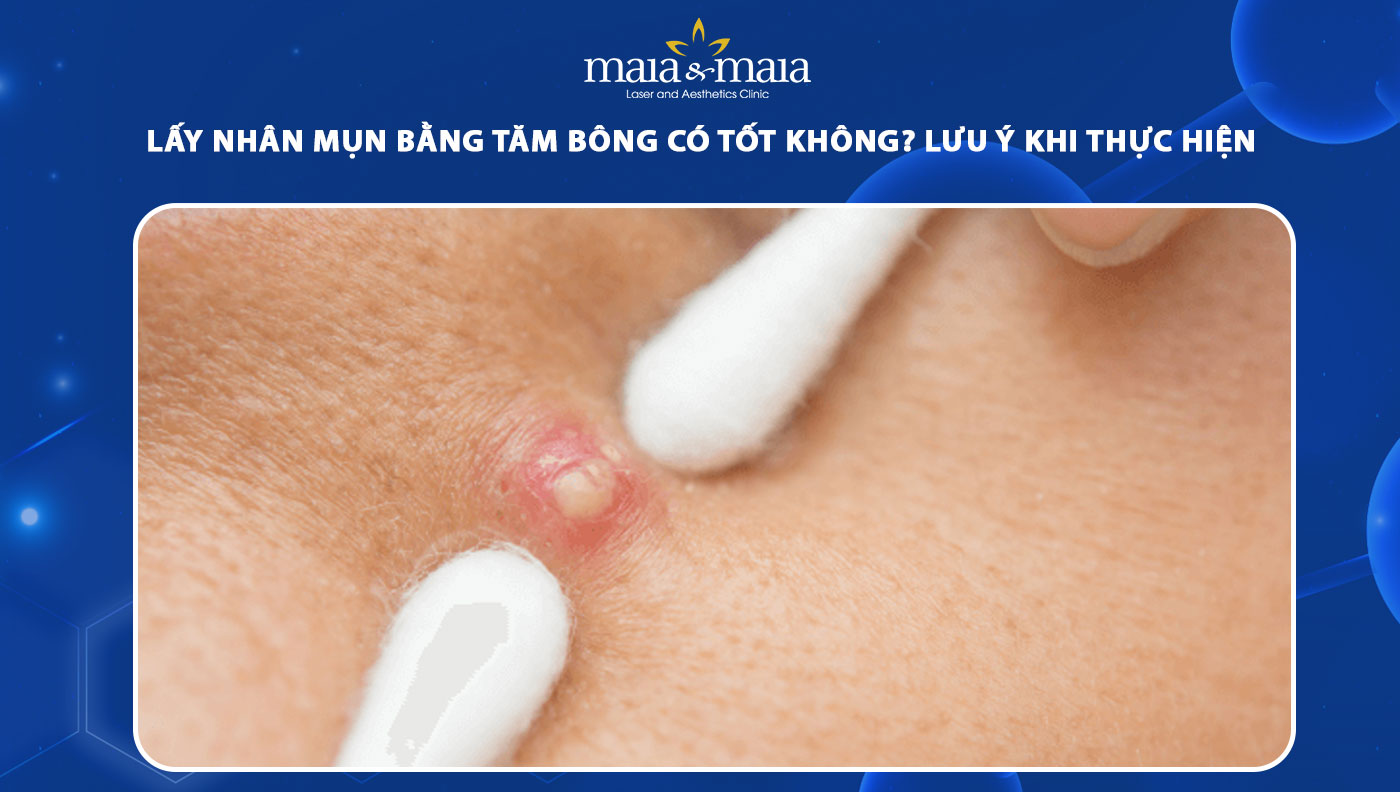 Nặn Mụn Bằng Tăm Bông: Có Nên Hay Không?