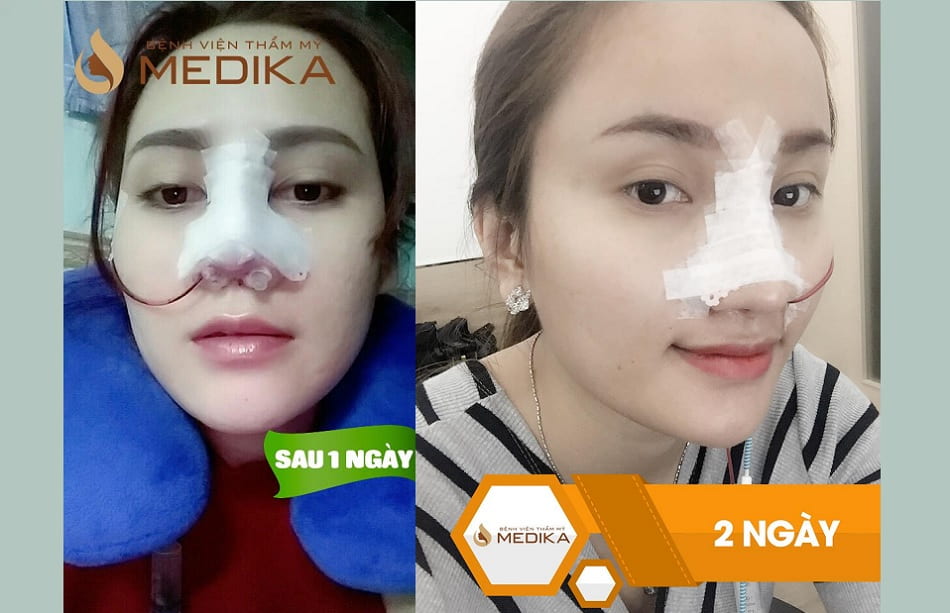 Nâng Lưu là gì? Hướng dẫn chi tiết về kỹ thuật Nâng Lưu hiệu quả Gallery 2
