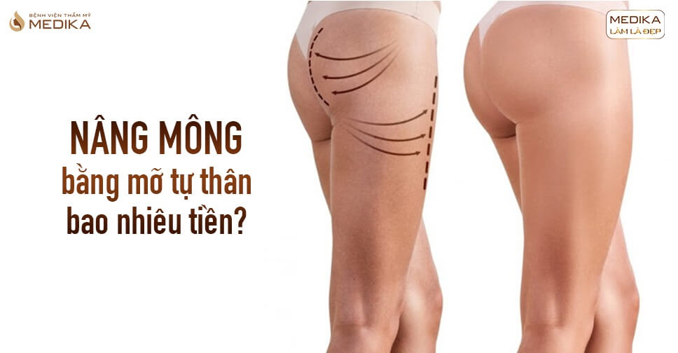 Nâng mông bằng mỡ tự thân bao nhiêu tiền?