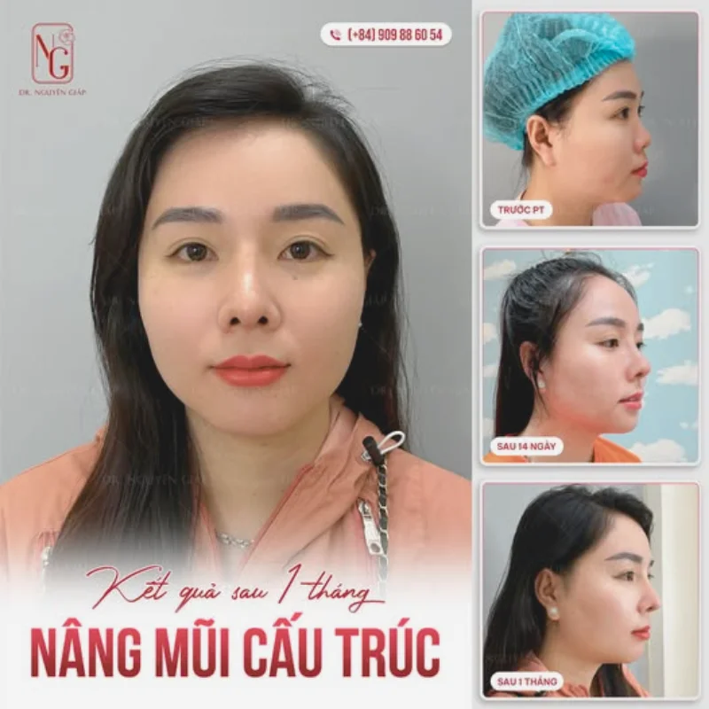 Nâng mũi bao lâu thì được xì mũi? Gallery 2