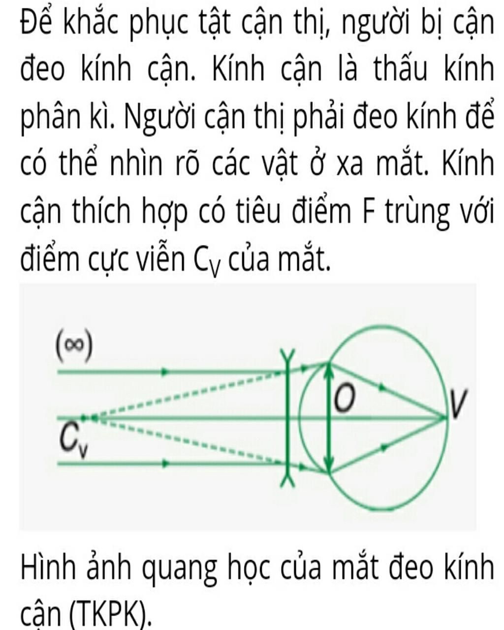 Đặc điểm của tật cận thị và cách khắc phục