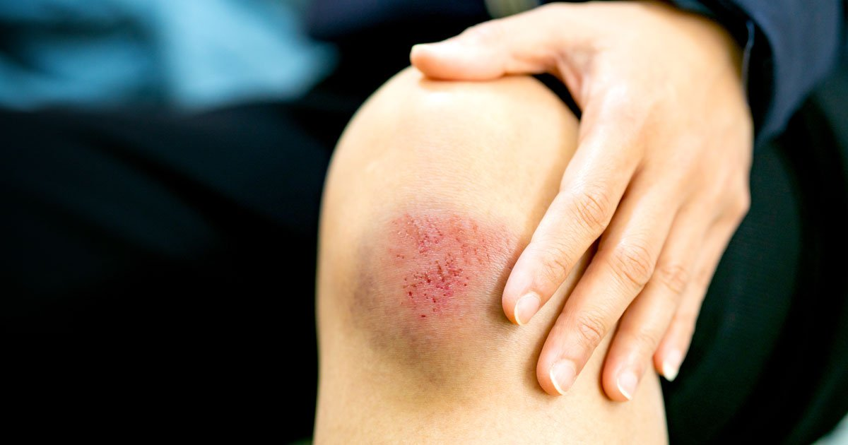 Ngã xe xước chân: Cách sơ cứu và điều trị hiệu quả