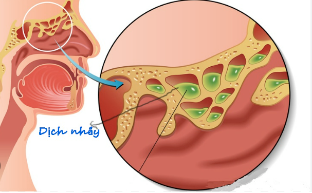 Nghẹt 2 Bên Mũi: Nguyên Nhân, Triệu Chứng Và Cách Khắc Phục