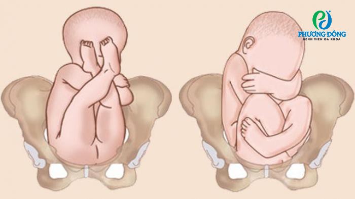 Ngôi Thai Ngược Nên Mổ Ở Tuần Bao Nhiêu?