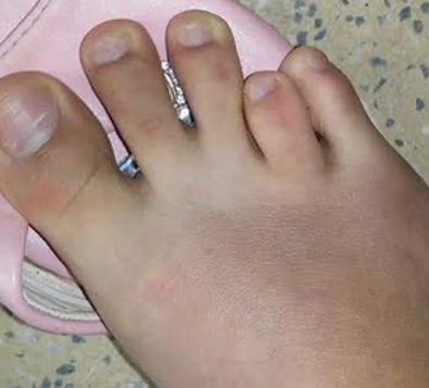 Ngón Chân Áp Út Ngắn Hơn Ngón Út: Nguyên Nhân Và Điều Cần Biết