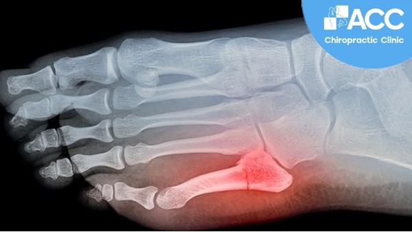 Ngón Chân Út Bị Đau: Nguyên Nhân, Triệu Chứng Và Cách Điều Trị