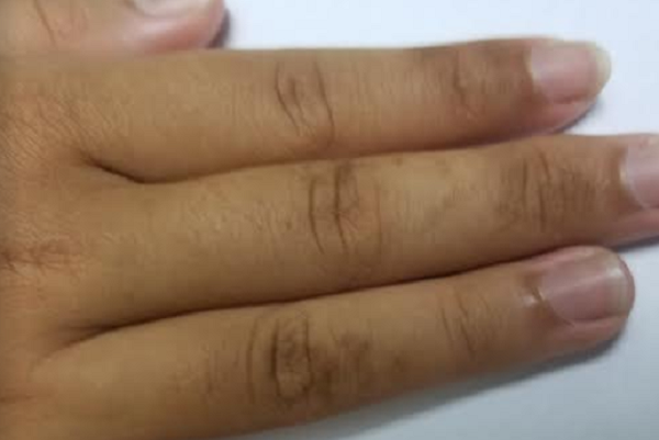 Ngón Tay Bị Nám Đen: Nguyên Nhân Và Cách Điều Trị