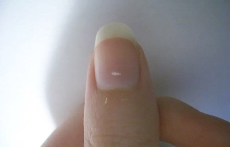 Ngón Tay Có Đốm Trắng: Nguyên Nhân và Cách Xử Lý