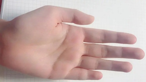 Ngón Tay Út Ngắn: Nguyên Nhân, Ảnh Hưởng và Cách Khắc Phục