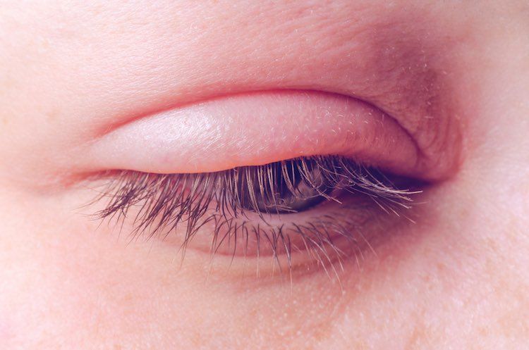 Ngủ dậy bị đau một bên mắt phải