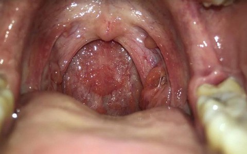 Ngủ dậy bị khô họng: Nguyên nhân và cách khắc phục