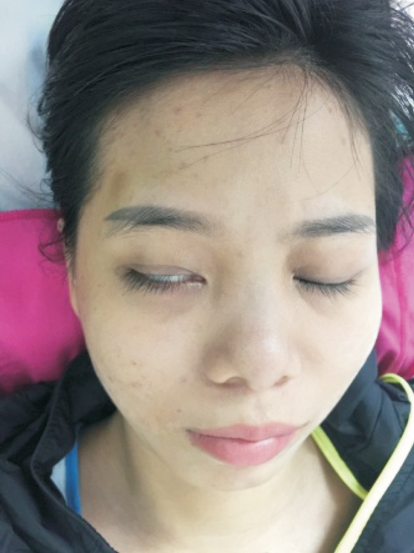 Ngủ Mắt Nhắm Không Kín: Nguyên Nhân và Cách Khắc Phục
