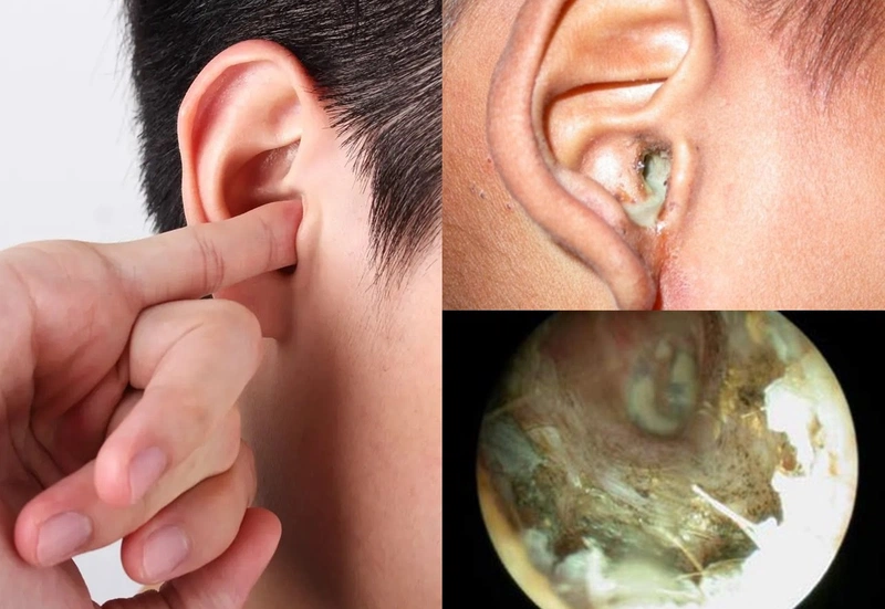 Ngứa Lỗ Tai Bên Trái: Nguyên Nhân Và Cách Khắc Phục