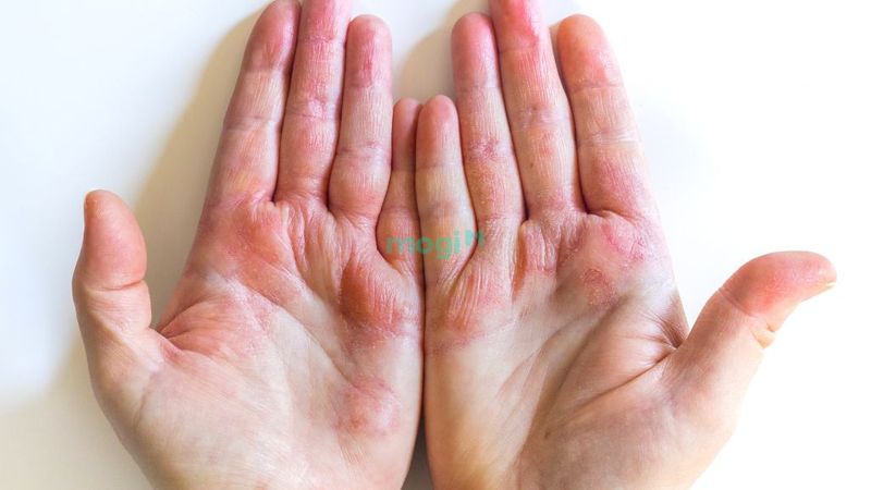 Ngứa lòng bàn tay là điềm gì? Gallery 2