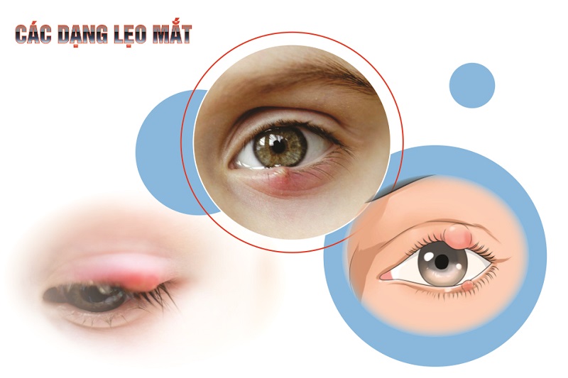 Lẹo Đẽo Là Gì? Gallery 1