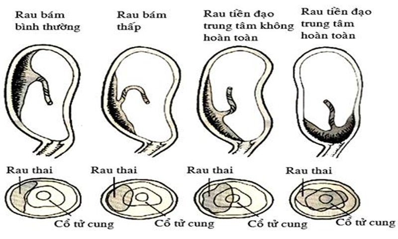 Nhau Bám Đáy Tử Cung Gallery 1