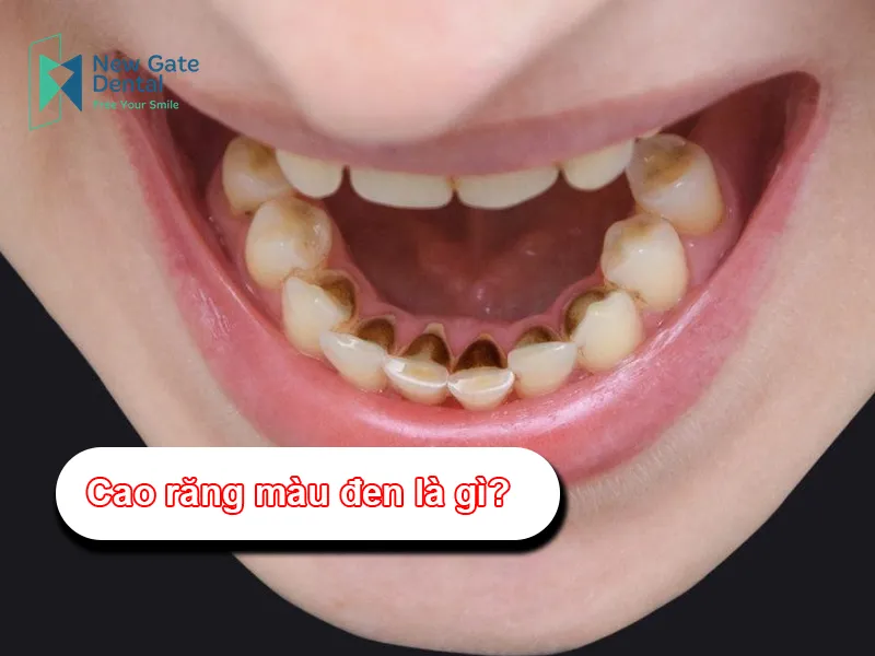 Cao răng màu đen: Nguyên nhân, nguy hiểm và cách xử lý Gallery 2