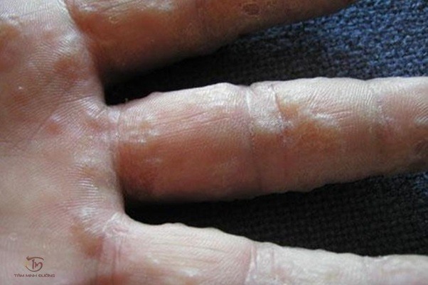 Nguyên nhân bị tổ đỉa