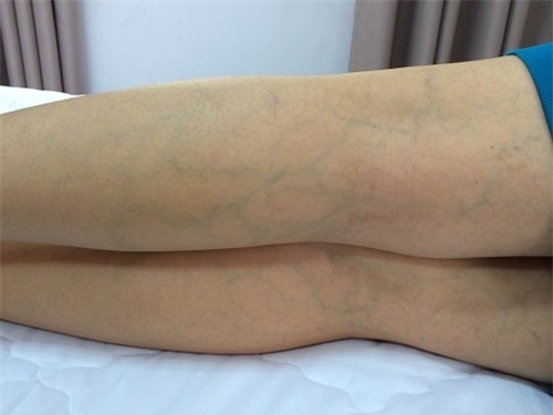 Chân bị nổi gân xanh: Nguyên nhân, triệu chứng và cách điều trị Gallery 1