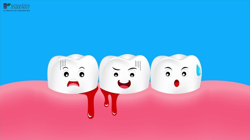Chảy máu chân răng không cầm được: Nguyên nhân và cách xử trí Gallery 1