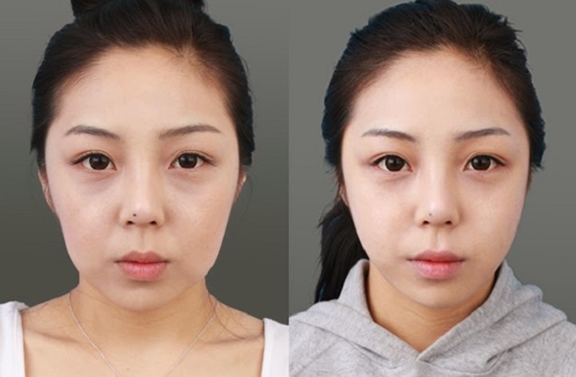 Da mặt chảy xệ ở tuổi dậy thì: Nguyên nhân và cách khắc phục Gallery 1
