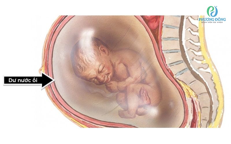 Cách Khắc Phục Dư Nước ối Gallery 1