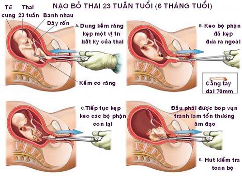 Bài Thuyết Trình Về Nạn Nạo Phá Thai Gallery 2