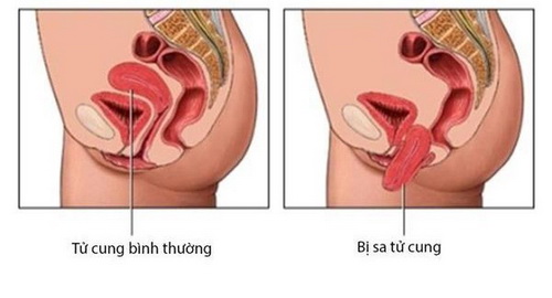 Sa cơ là gì? Định nghĩa, giải thích và ví dụ Gallery 2