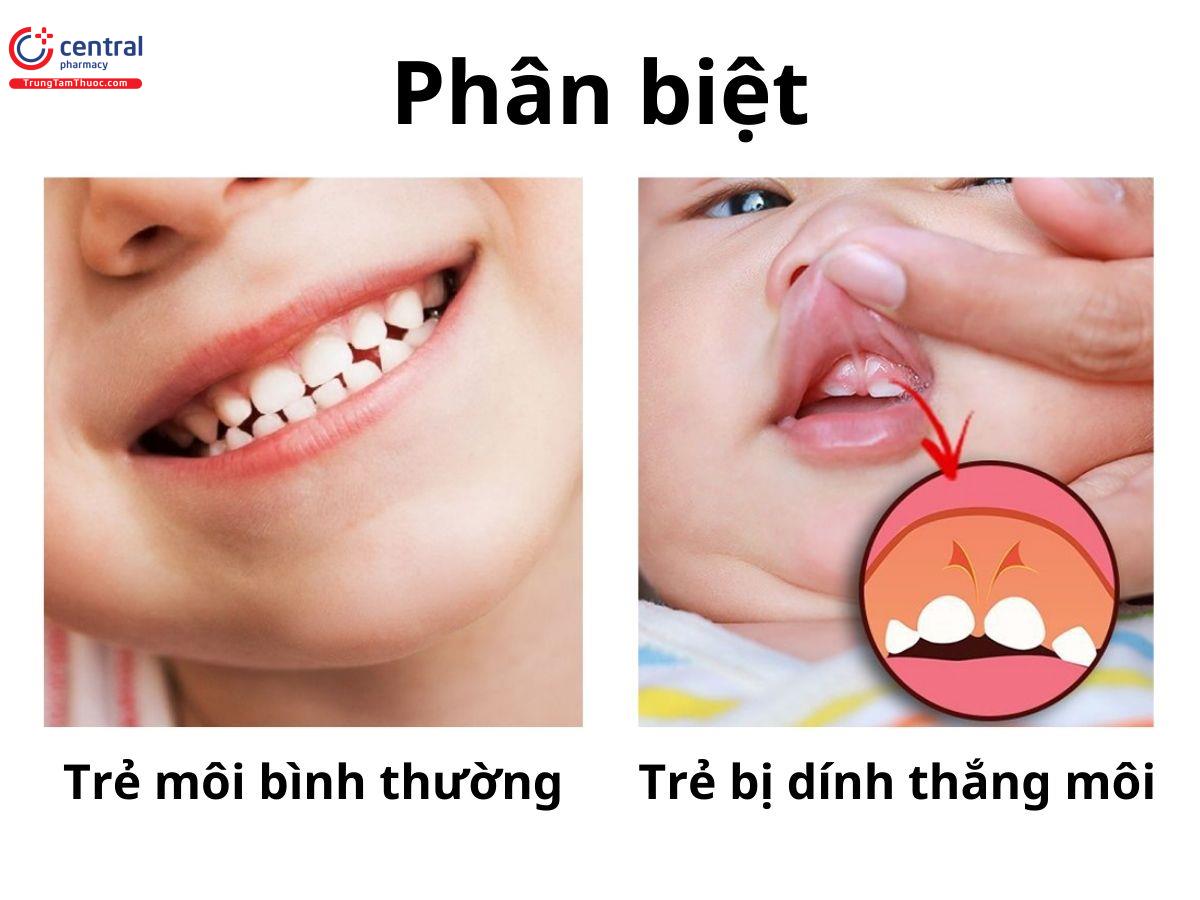 Dính Phanh Môi Trên: Nguyên Nhân, Triệu Chứng Và Cách Điều Trị Gallery 1
