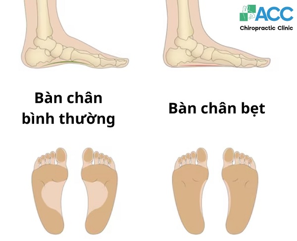 Bàn Chân Bẹt Ở Người Lớn Gallery 1