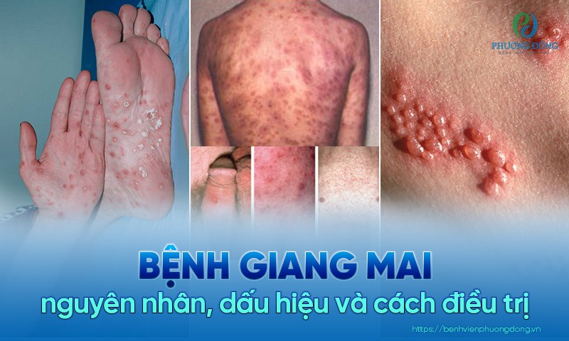 Giang Mai Là Gì? Gallery 1