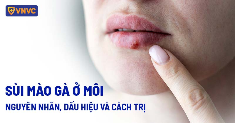 Sùi mào gà là gì? Gallery 1