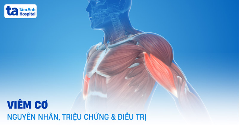 Xa Cơ Là Gì? Tìm Hiểu Về Bệnh Xa Cơ Gallery 1
