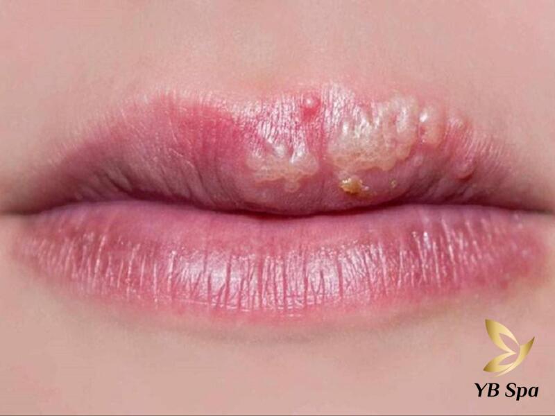 Xăm môi bị bọng nước phải làm sao? Gallery 1
