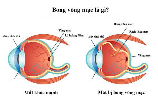 Bong võng mạc là gì? Gallery 1