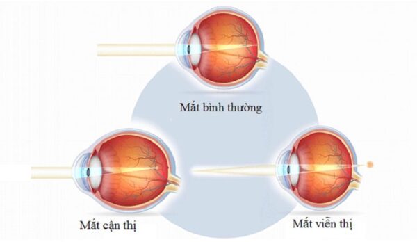 Nguyên nhân và cách khắc phục tật cận thị viễn thị Gallery 1
