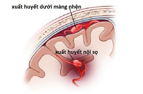 Chảy máu dưới nhện Gallery 1