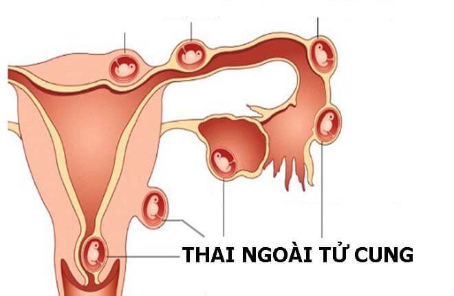 Chửa Ngoài Tử Cung Vỡ Gallery 2
