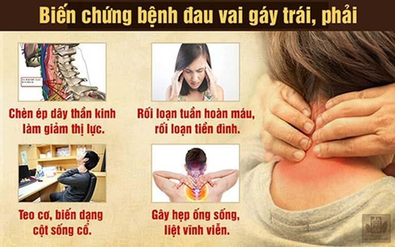 Cứng Cổ Vai Gáy: Nguyên Nhân, Triệu Chứng và Cách Điều Trị Gallery 1