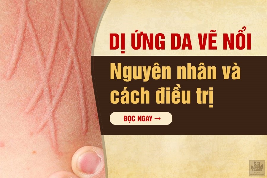 Da Vẽ Nổi Ngứa: Nguyên Nhân, Triệu Chứng Và Cách Điều Trị Gallery 1