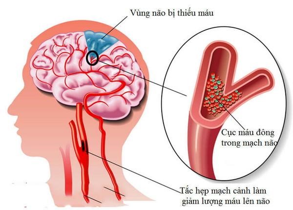Ngủ Dậy Đau Đầu: Nguyên Nhân và Cách Khắc Phục Gallery 1