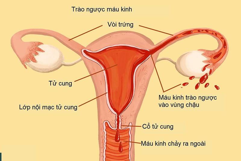 Cơn Đau Lạc Nội Mạc Tử Cung Gallery 1