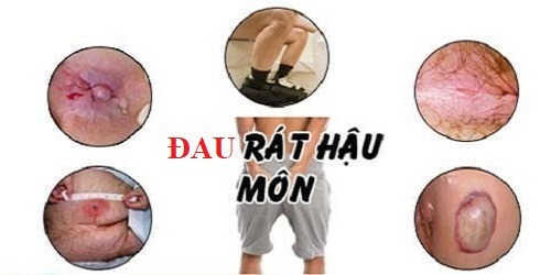 Đau Rát Xung Quanh Hậu Môn: Nguyên Nhân, Điều Trị và Phòng Ngừa Gallery 1