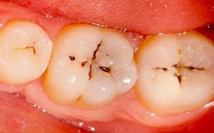 Răng bị đen ở kẽ: Nguyên nhân và cách khắc phục Gallery 1