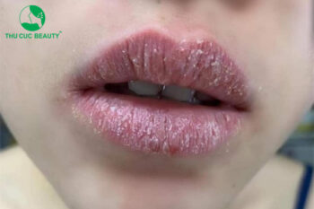 Dị ứng Mực Xăm: Nguyên Nhân, Triệu Chứng và Cách Điều Trị Gallery 1