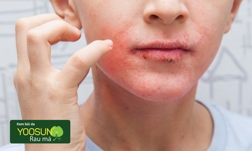 Dị ứng nước mưa là gì? Nguyên nhân, triệu chứng và cách điều trị Gallery 1