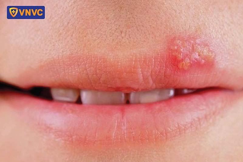 Bị Dời Ở Miệng: Nguyên Nhân, Triệu Chứng Và Cách Điều Trị Gallery 1